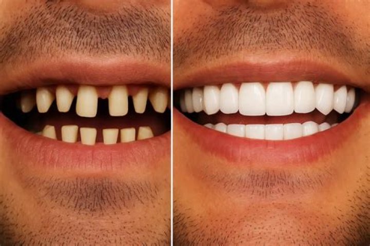 Glimpse Of Anthony Davis Before And After Teeth