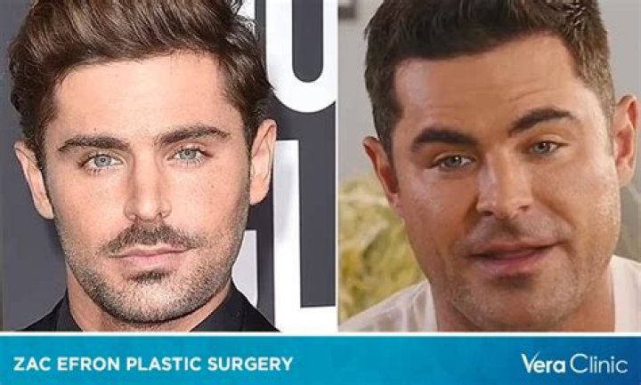 Zac Efron Face Accident: Did He Have A Plastic Surgery? Before And After